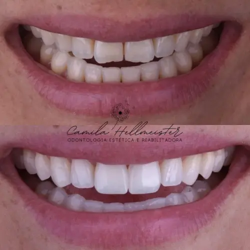 Transformação Completa do Sorriso